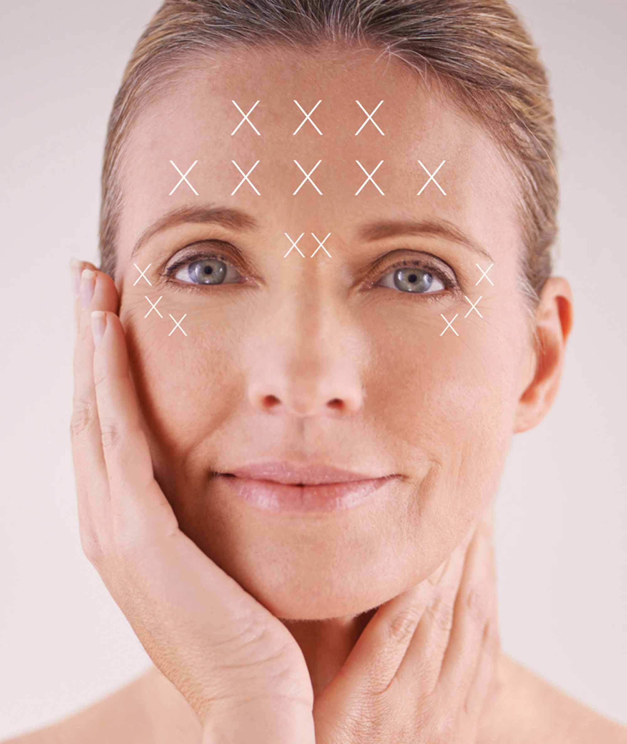 Model with lines across middle of forehead, between brows & crows feet show where to use Insta-Firm Advanced Wrinkle Relaxer