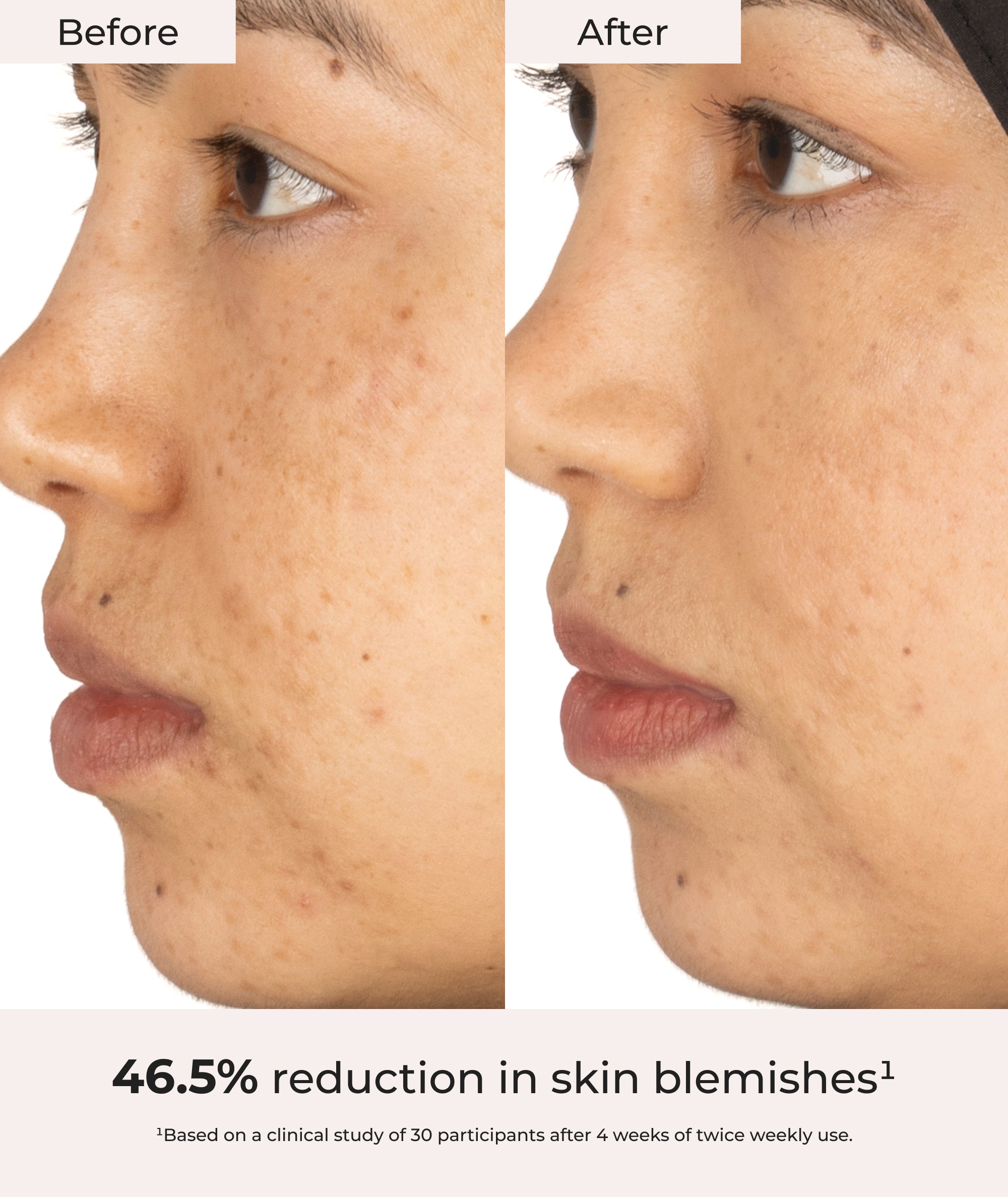 A before and after shot of a model showing 46.5% reduction in skin blemishes.